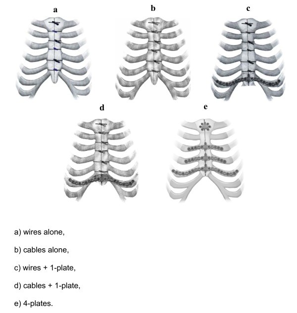 Sternal plating for primary and secondary sternal closure; can it improve sternal stability