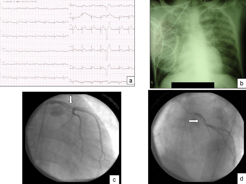 Acute left main coronary artery thrombosis due to cocaine use | Journal ...