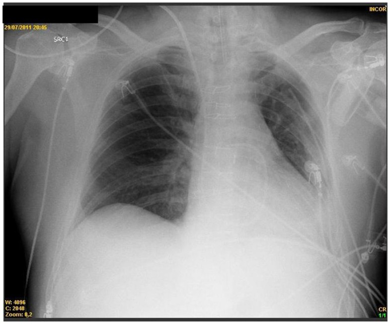 Alveolar recruitment maneuver in refractory hypoxemia and lobar