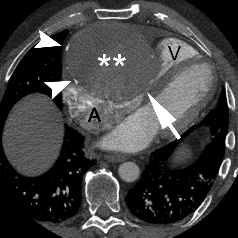 An unruptured, thrombosed 10 cm right coronary artery aneurysm ...