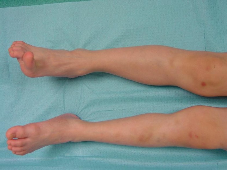 Ehlers-Danlos syndrome type IV | Orphanet Journal of Rare Diseases