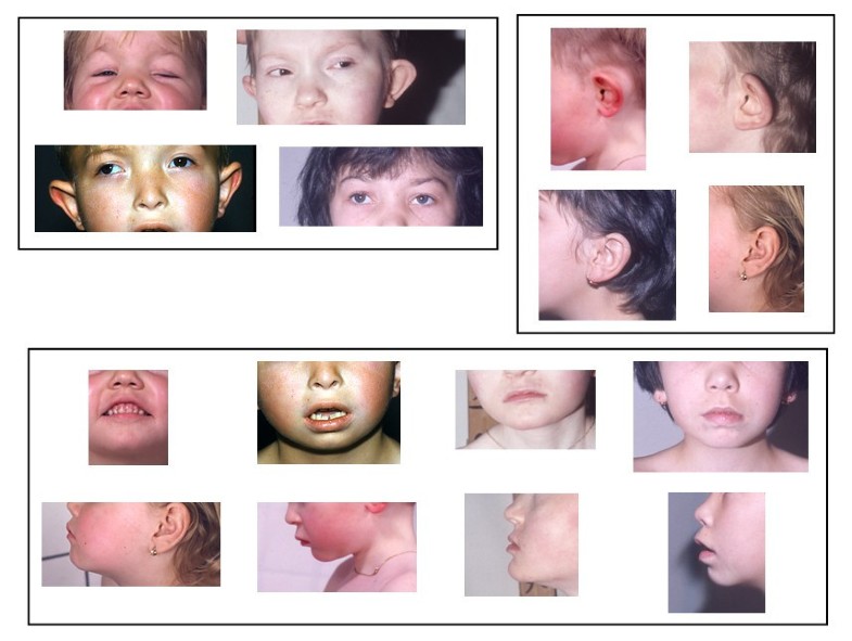 Monosomy 18p Journal of Rare Diseases Full Text