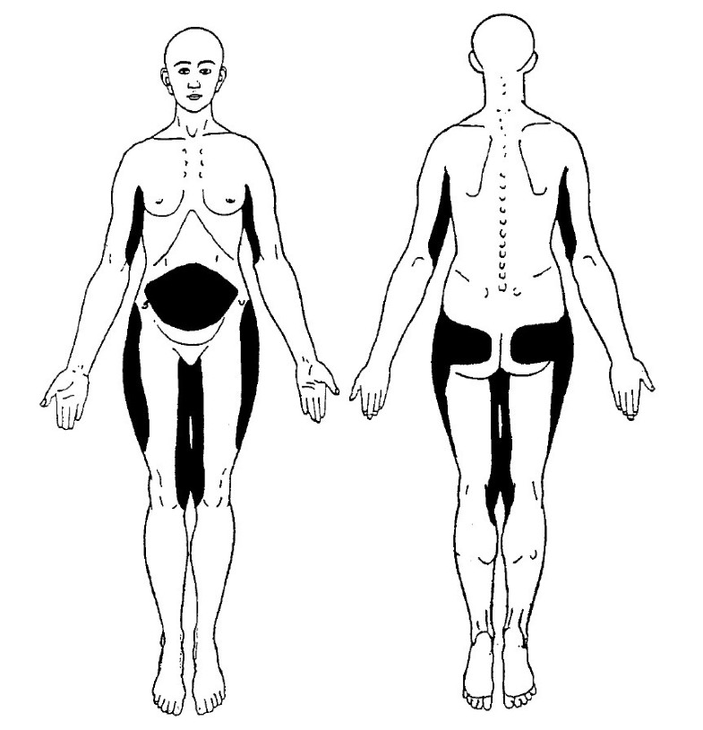 Review of Dercum’s disease and proposal of diagnostic criteria