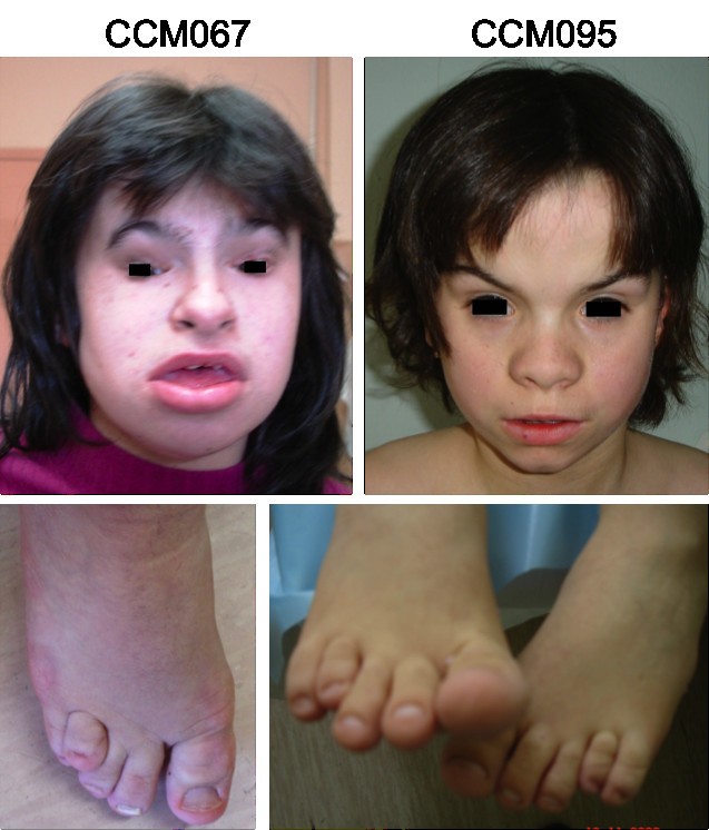 DandyWalker malformation and Wisconsin syndrome novel cases add