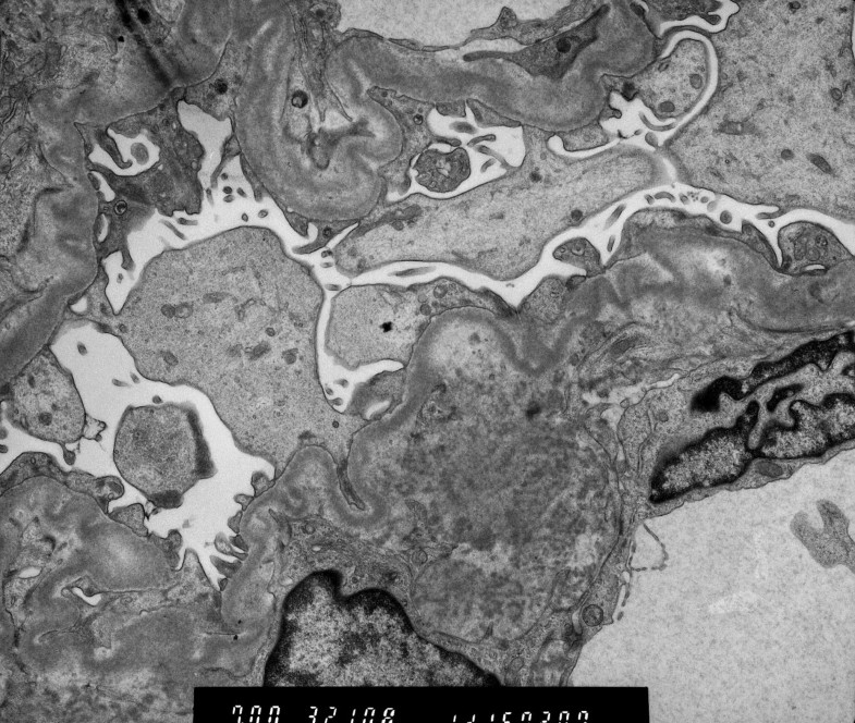 Light chain deposition disease presenting as paroxysmal atrial