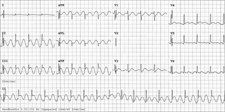 Pneumopericardium should be considered with electrocardiogram changes ...