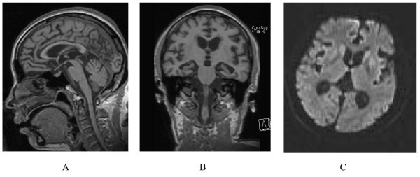 Human prion disease with a G114V mutation and epidemiological studies