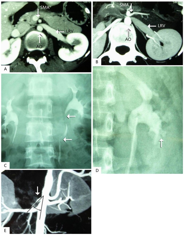 Management of renal nutcracker syndrome by retroperitoneal laparoscopic