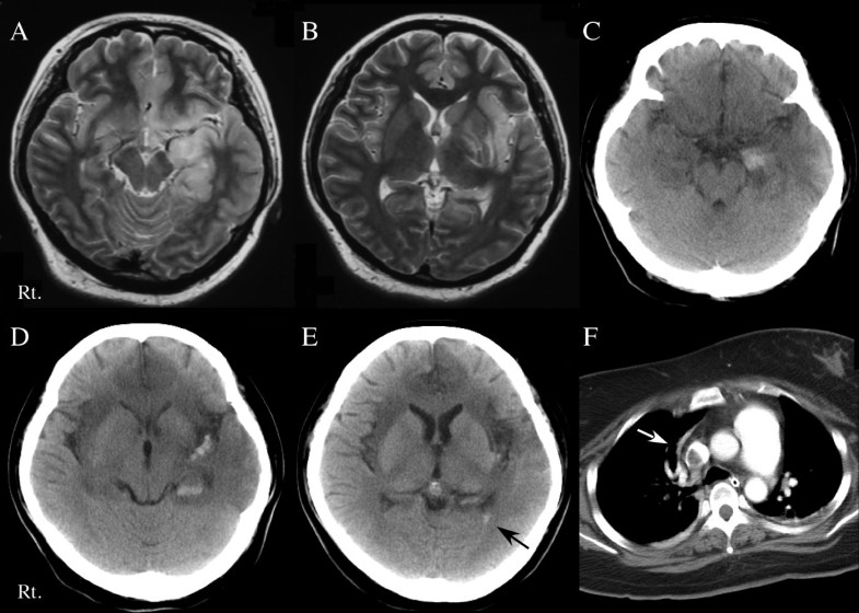 A successfully treated case of herpes simplex encephalitis complicated ...