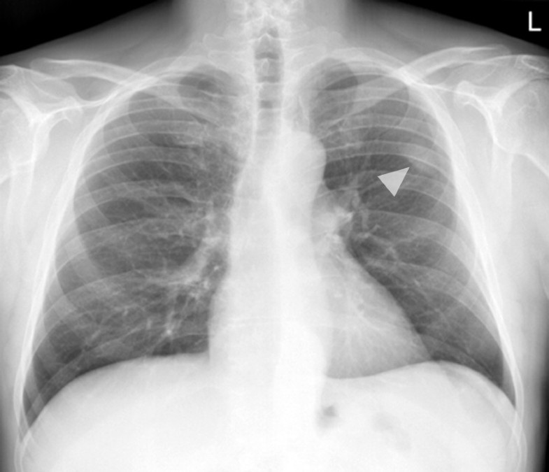 Computed tomography imaging of subpleural lipoma in two men: two case ...