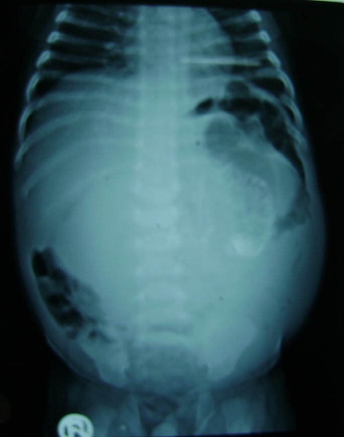 twin fetus in fetu in a child a case report and review of literature review outline