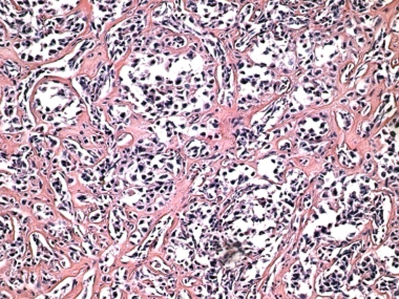 Clear cell variant of diffuse large Bcell lymphoma a case report