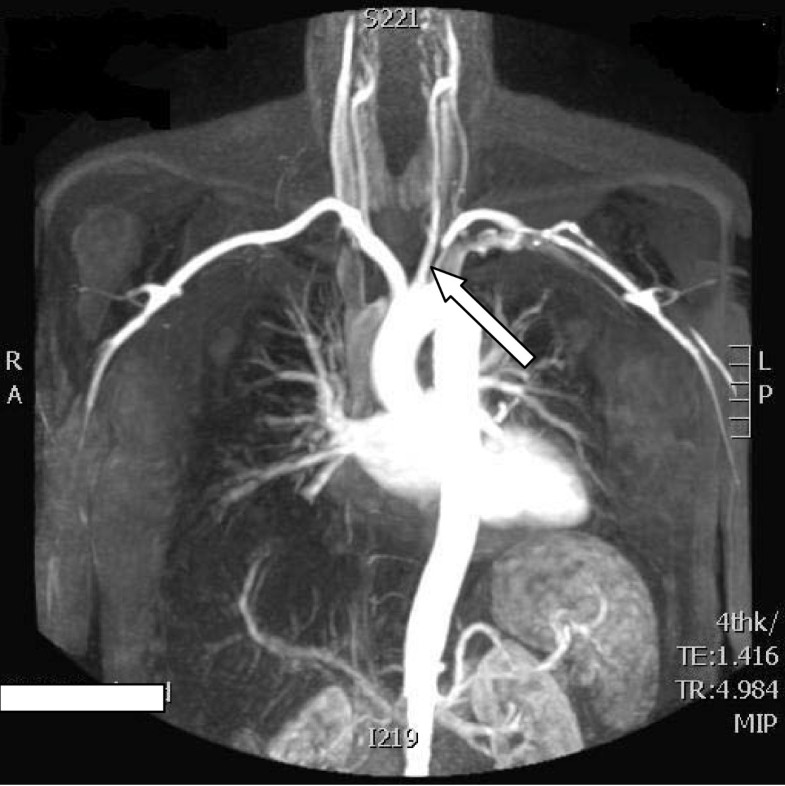 Carotid Axillary Bypass In A Patient With Blocked Subclavian Stents A 
