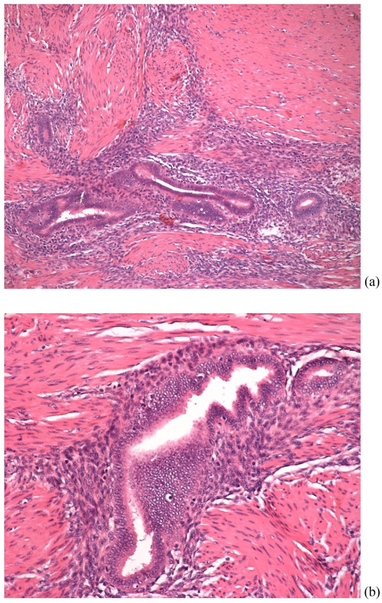 Rectal endometriosis causing colonic obstruction and concurrent