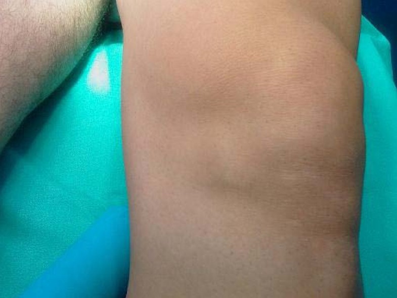 Large infrapatellar ganglionic cyst of the knee fat pad a case report