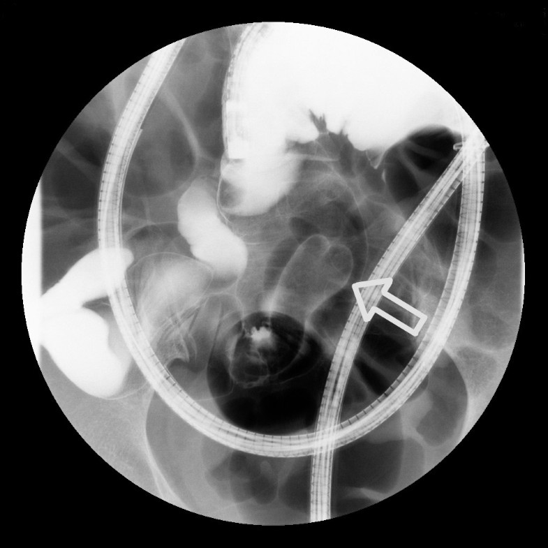 Endoscopic ultrasound with doubleballoon endoscopy for the diagnosis of inverted Meckel’s