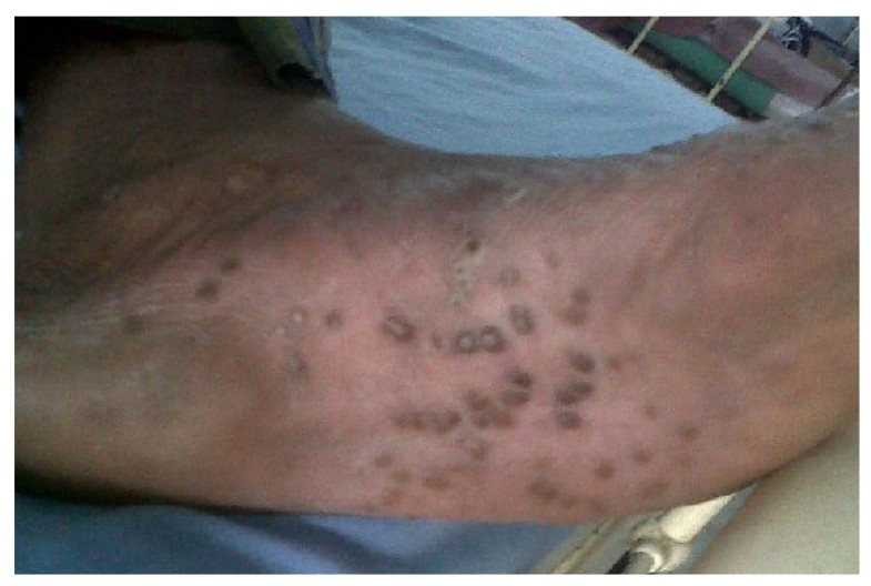 Disease flare of ankylosing spondylitis presenting as