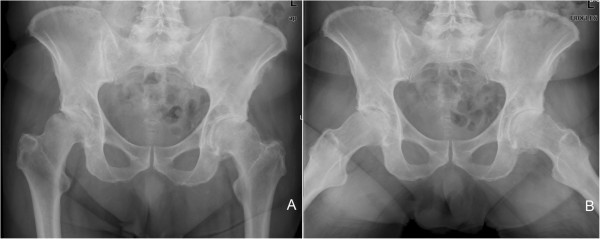 An atypically located large subchondral cyst in an osteoarthritic hip