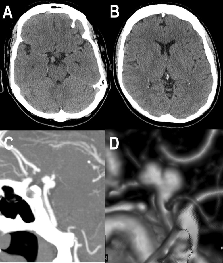 Cerebral aneurysm presenting with aseptic meningitis: a case report ...