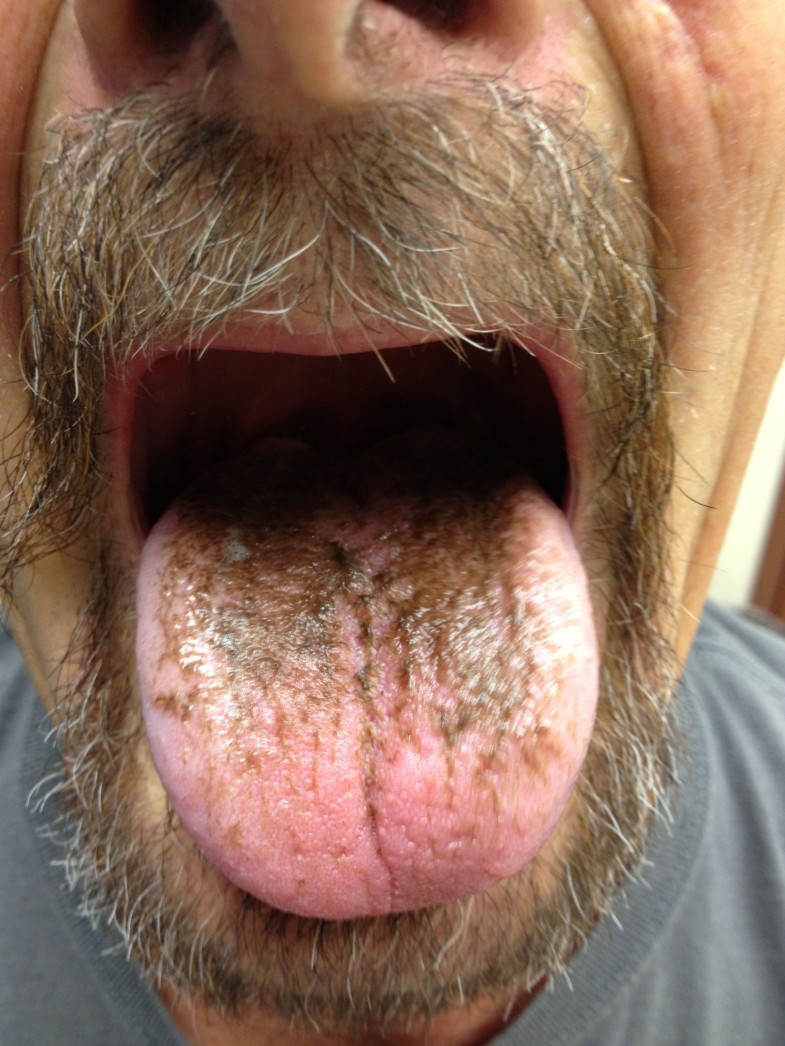 linezolid-induced-black-hairy-tongue-a-case-report-journal-of