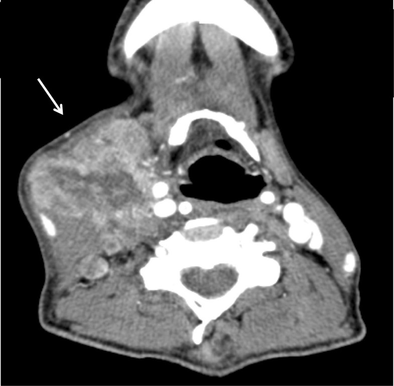 Large cell neuroendocrine carcinoma presenting with neck swelling in