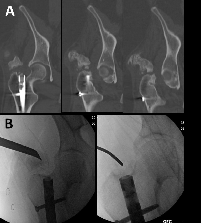 Heterotopic ossification in the reaming tract of a percutaneous