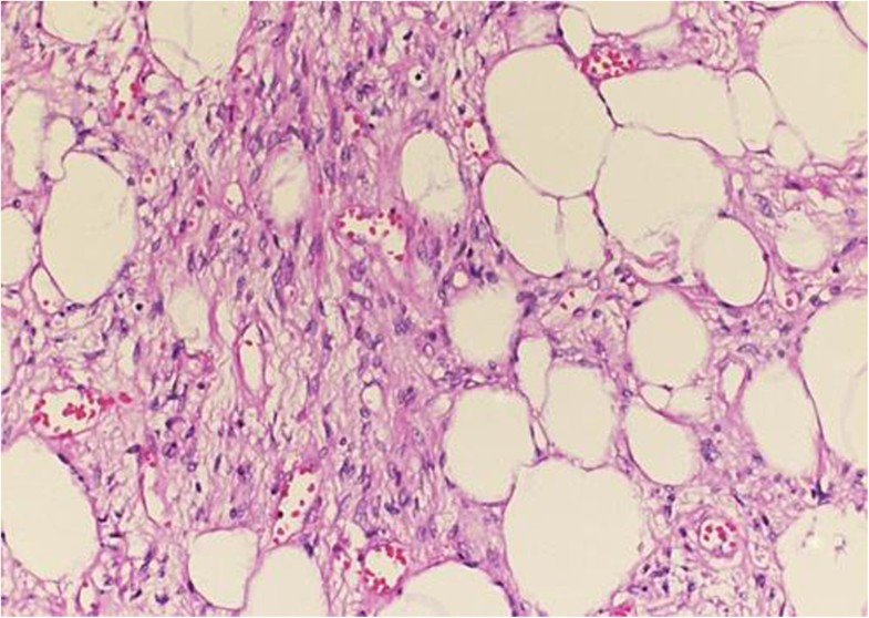 Vulvar lipoma a case report Journal of Medical Case Reports Full Text