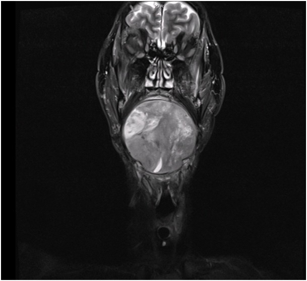 An adult spindle cell rhabdomyosarcoma in the head and neck region with