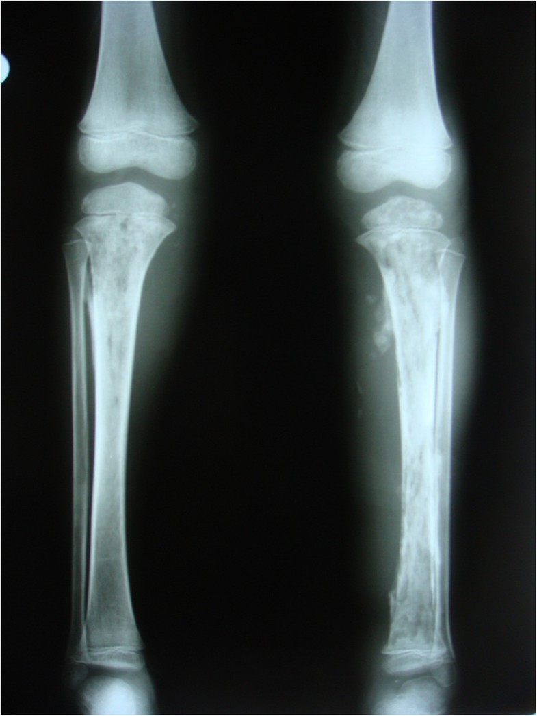 Bilateral acute tibial osteomyelitis in a patient without an underlying