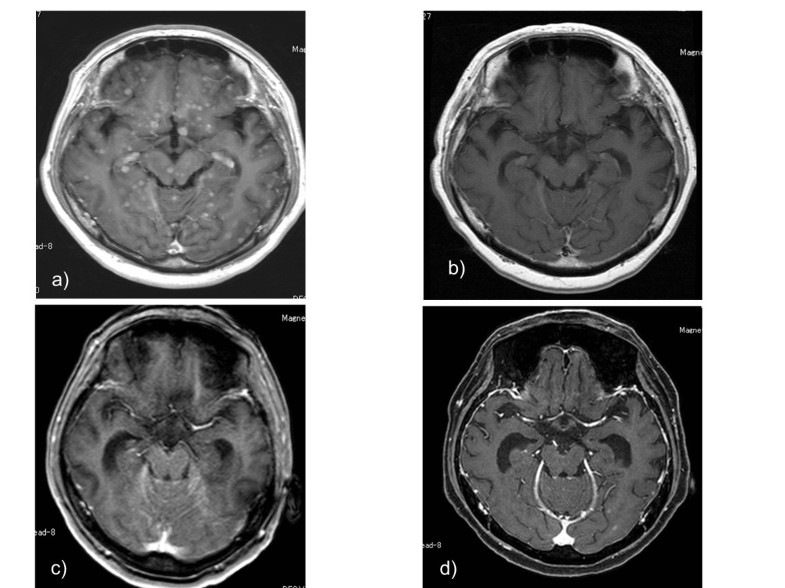 Brain Metastasis Effectively Treated With Erlotinib Following The