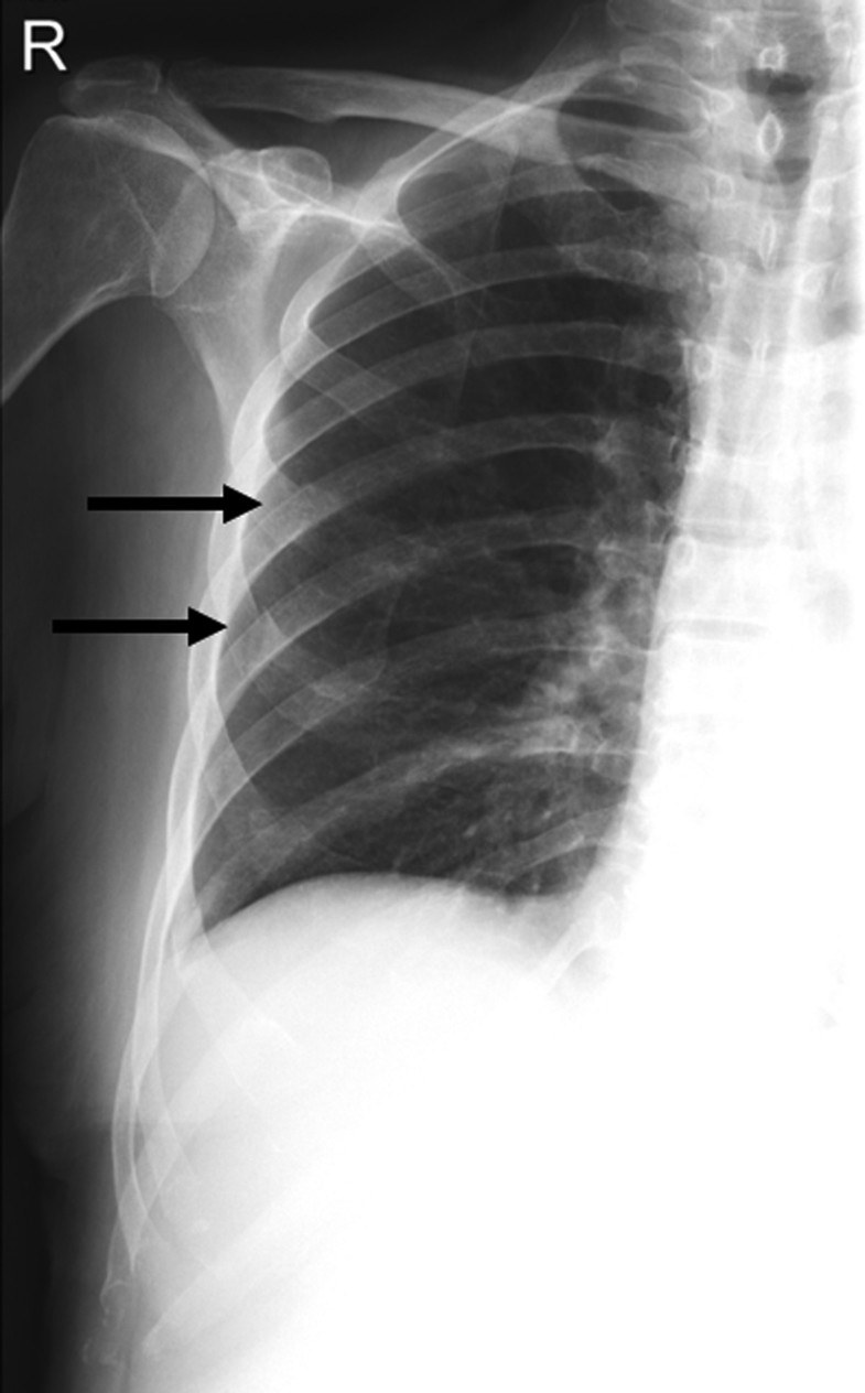 Diagnostic significance of rib series in minor thorax trauma compared