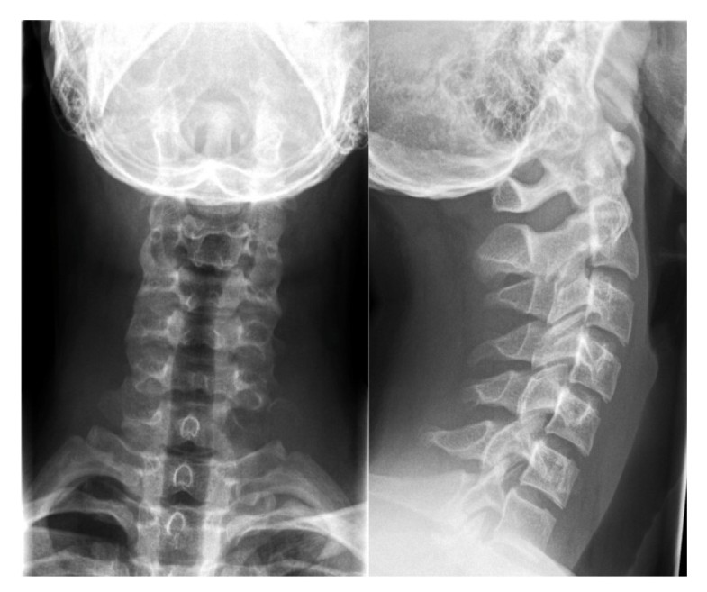 x ray cervical spine x ray cervical spine