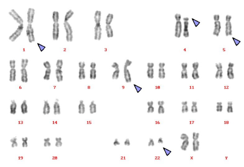 Novel complex translocation involving 5 different chromosomes in a ...