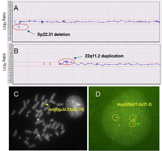 Clinical implementation of wholegenome array CGH as a firsttier test