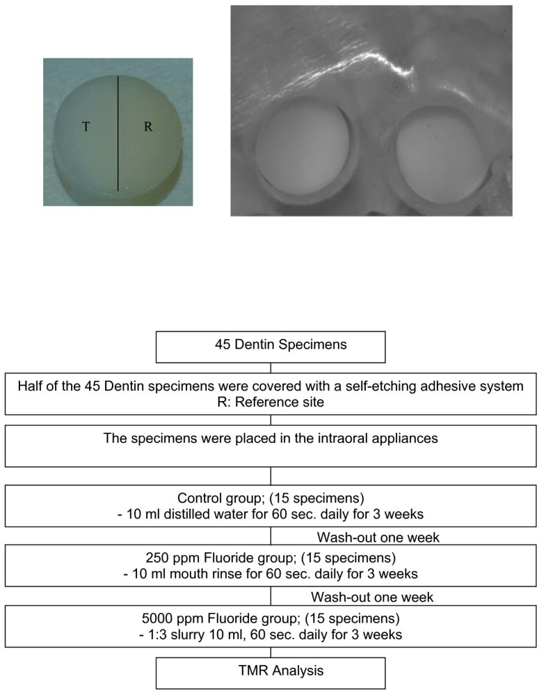 Effect of a 5000 ppm fluoride toothpaste and a 250 ppm fluoride mouth