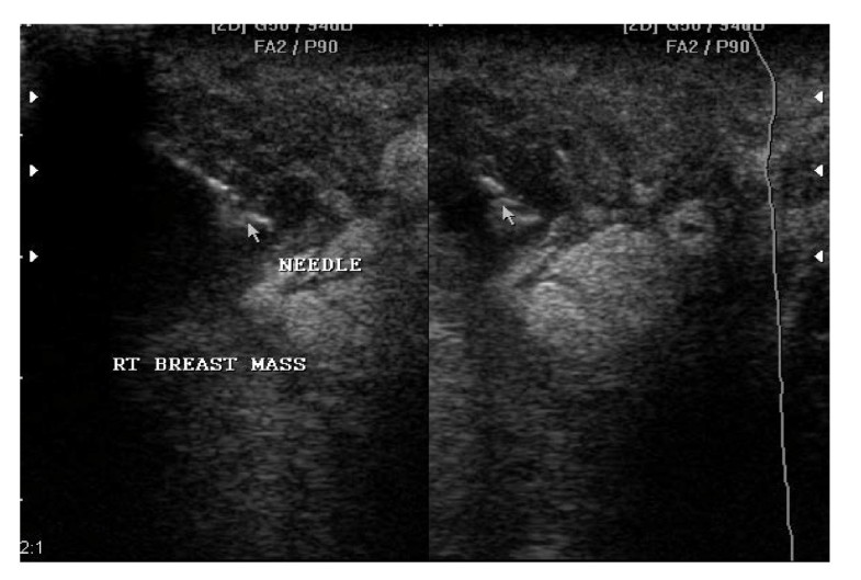 Ultrasound Guided Needle Aspiration versus Surgical Drainage in the