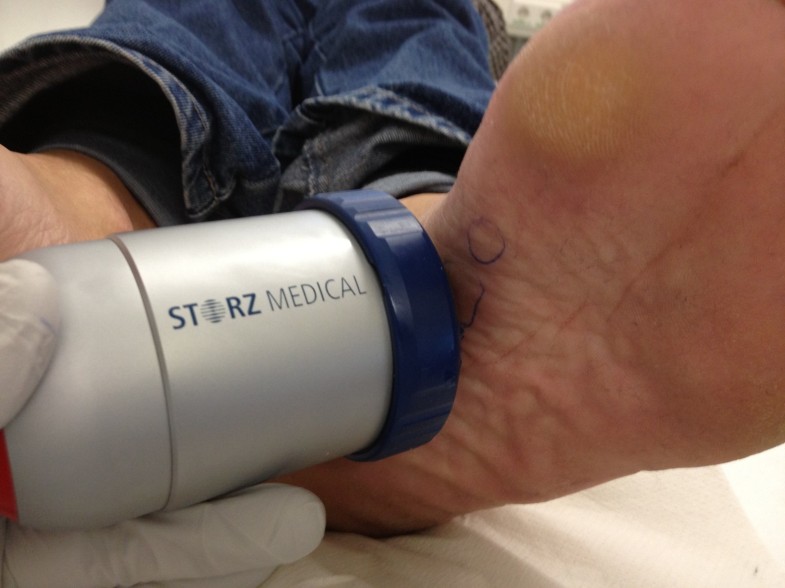 Highenergy focussed extracorporeal shockwave therapy reduces pain in