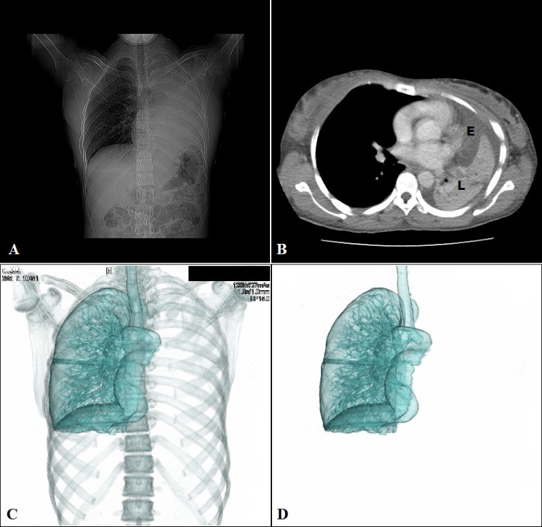 Massive hemoptysis and complete unilateral lung collapse in pregnancy due to pulmonary