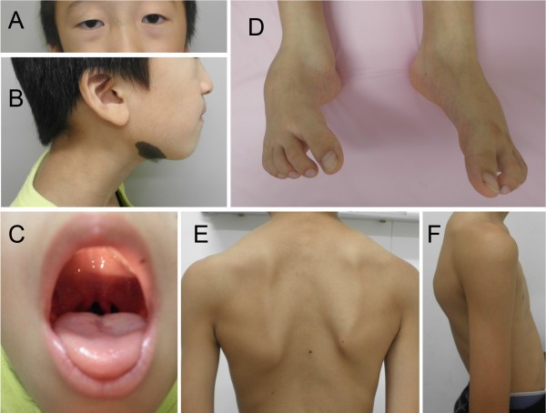 Systemic vascular phenotypes of Loeys-Dietz syndrome in a child