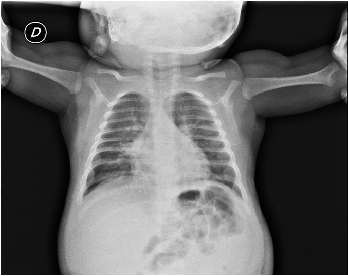 Severe Kawasaki disease in a 3monthold patient a case report BMC