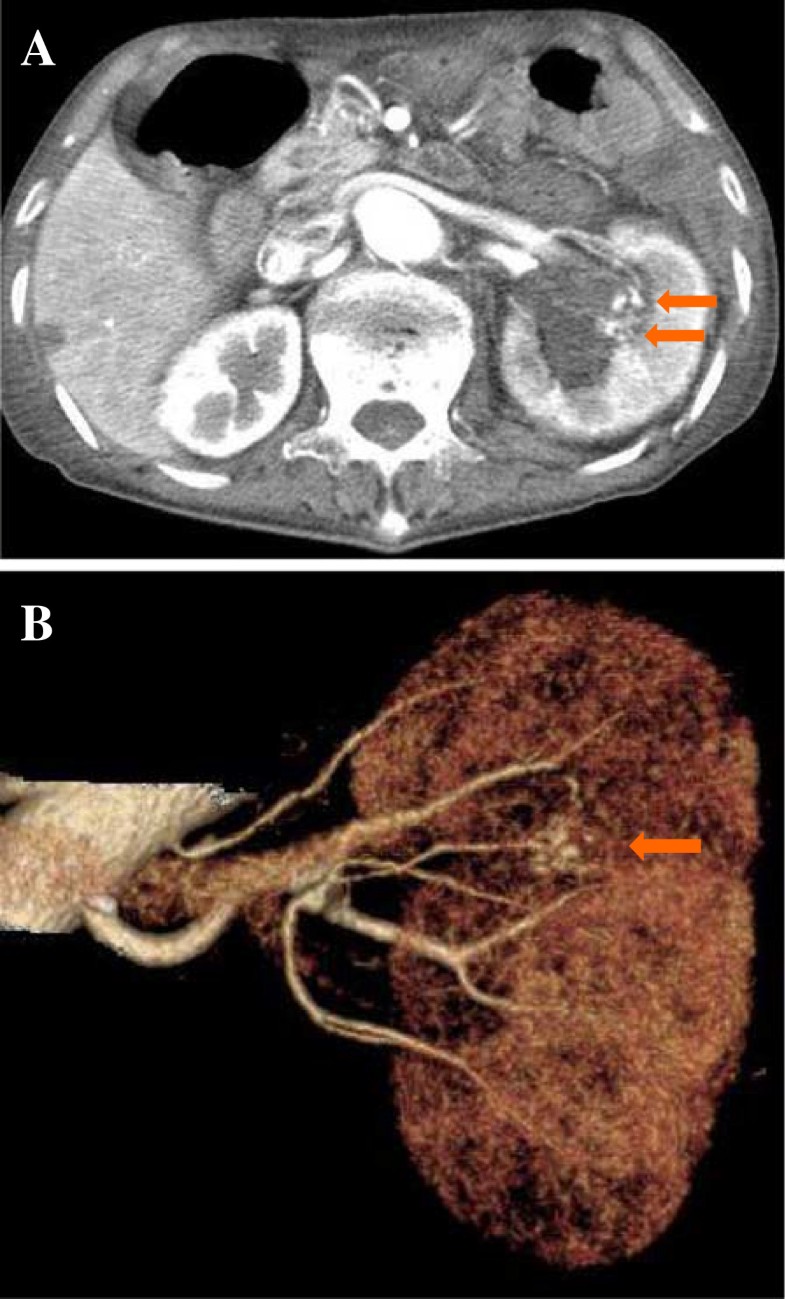 Ruptured renal arteriovenous malformation successfully treated by