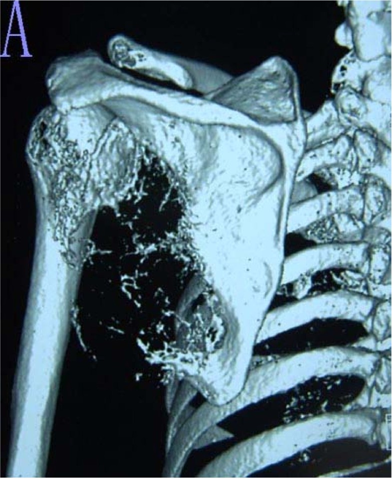 Surgical technique and clinical results for scapular allograft