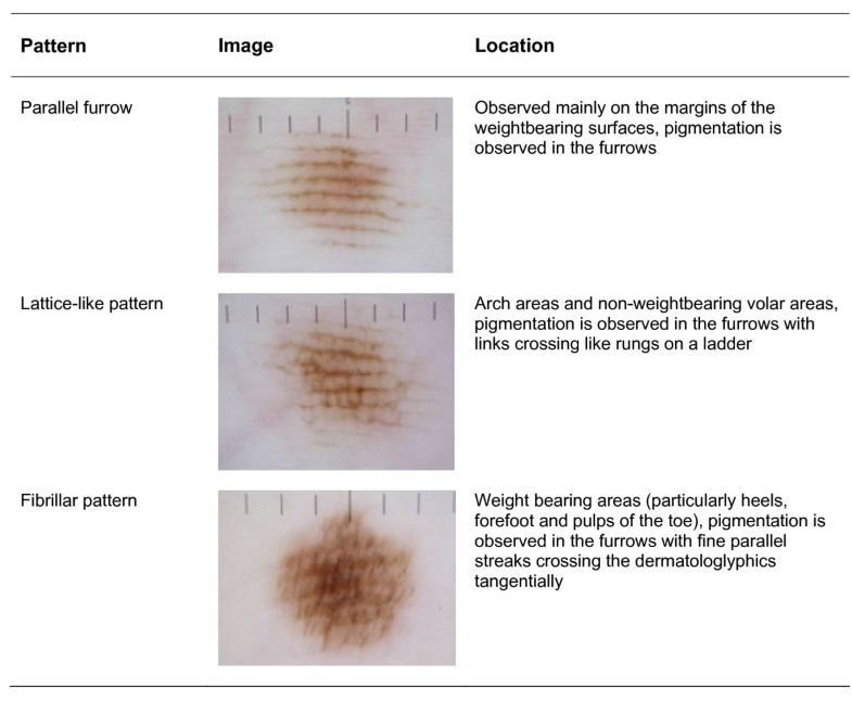 Dermoscopy as a technique for the early identification of foot melanoma