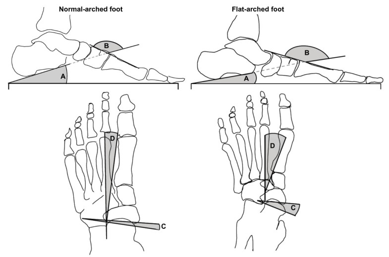 A protocol for classifying normal and flatarched foot posture for