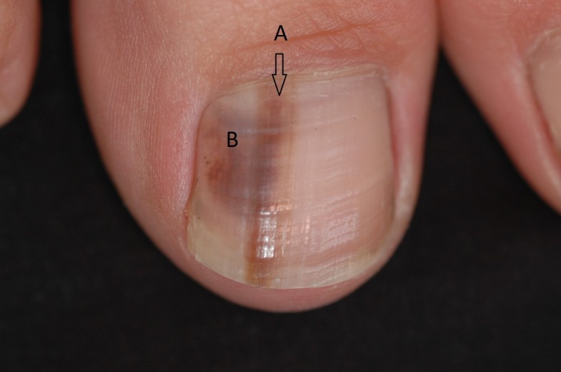 clinical-guidelines-for-the-recognition-of-melanoma-of-the-foot-and