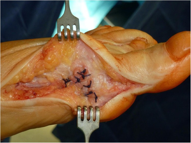 Surgical fixation of a joint