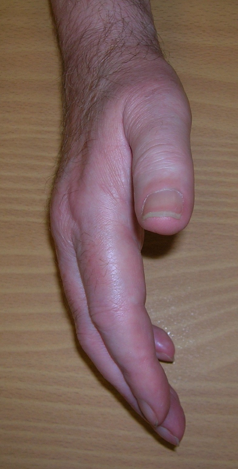 A diabetic patient presenting with stiff hand following fasciectomy for