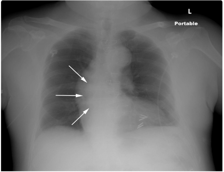 Aneurysm of an autologous aorta to right coronary artery