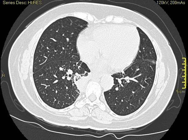 Limited Wegener's granulomatosis presenting as lung nodules in a