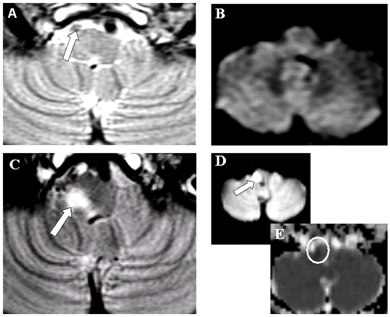 Diffusionnegative MRI in acute ischemic stroke a case report Cases